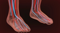 Managing Raynaud's Syndrome