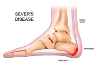 Symptoms and Risk Factors for Sever’s Disease